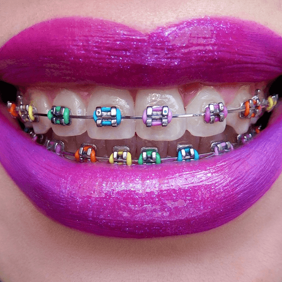 Braces