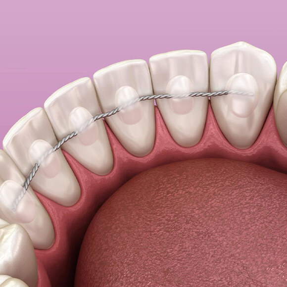 Types of Retainers