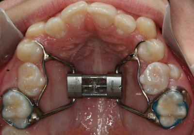 Rapid Maxillary Expander